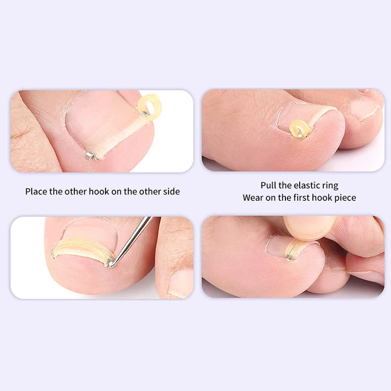 Ingrown Toenail Corrector Pedicure.