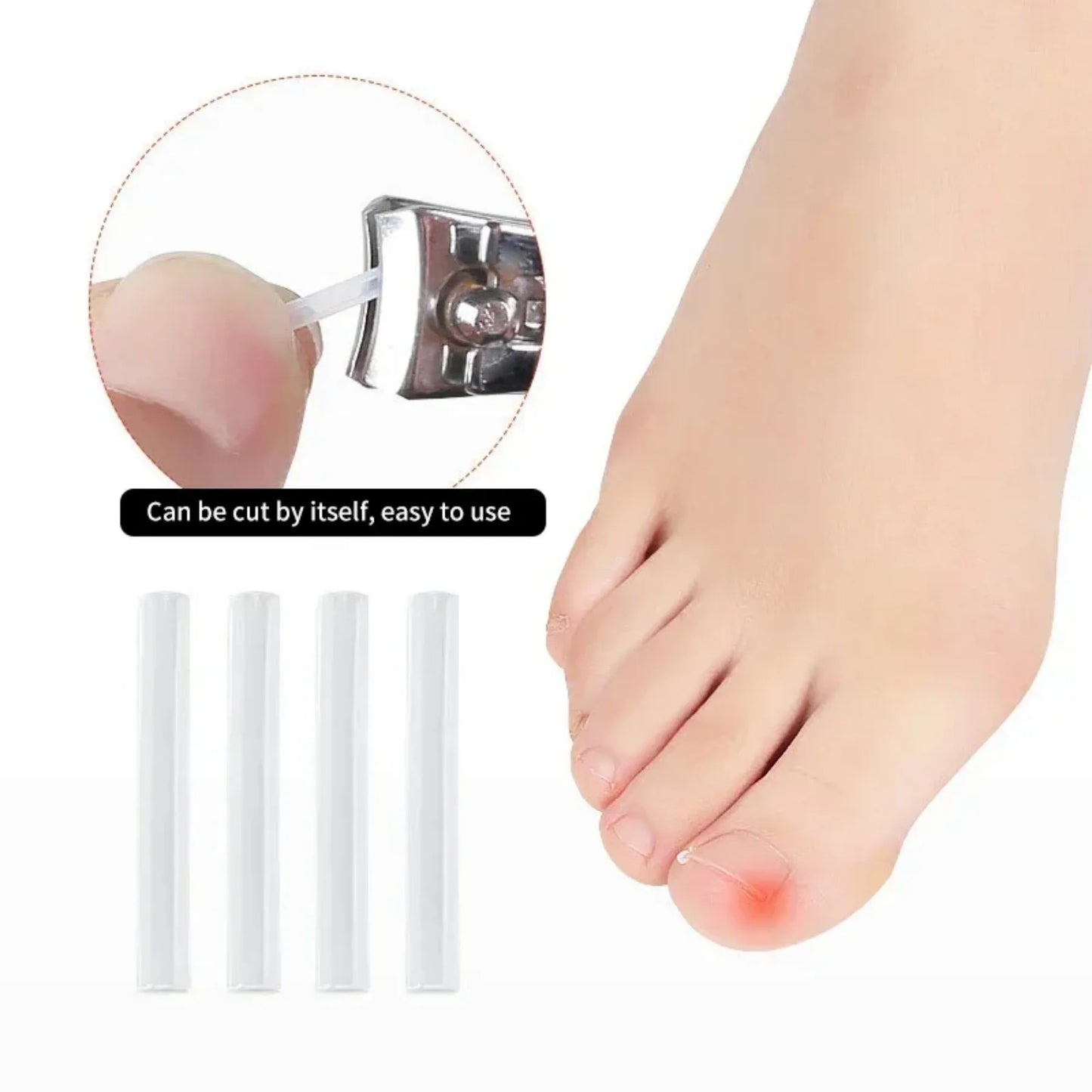 50Pcs Ingrown Toenail Correction Tool Ingrown Toe Nail Treatment Elastic.